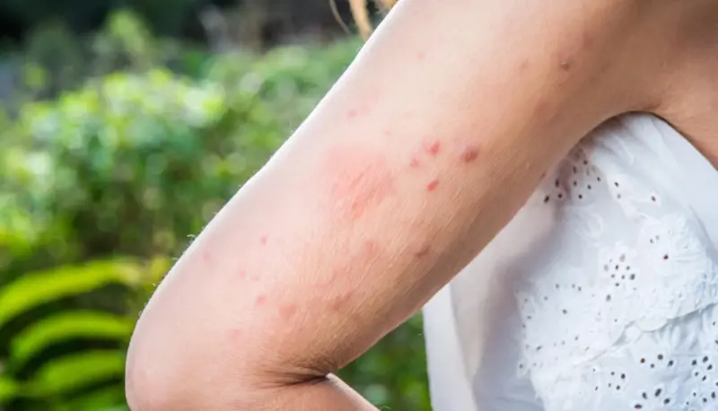 Cómo desinflamar la picadura de mosquito en minutos y cortar el picor de golpe