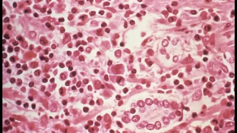Un epidemiólogo advierte en Onda Cero del periodo de incubación del hantavirus: "En algunos casos puede alargarse a cinc